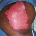 does pepper spray burn skin