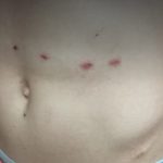 stun gun marks