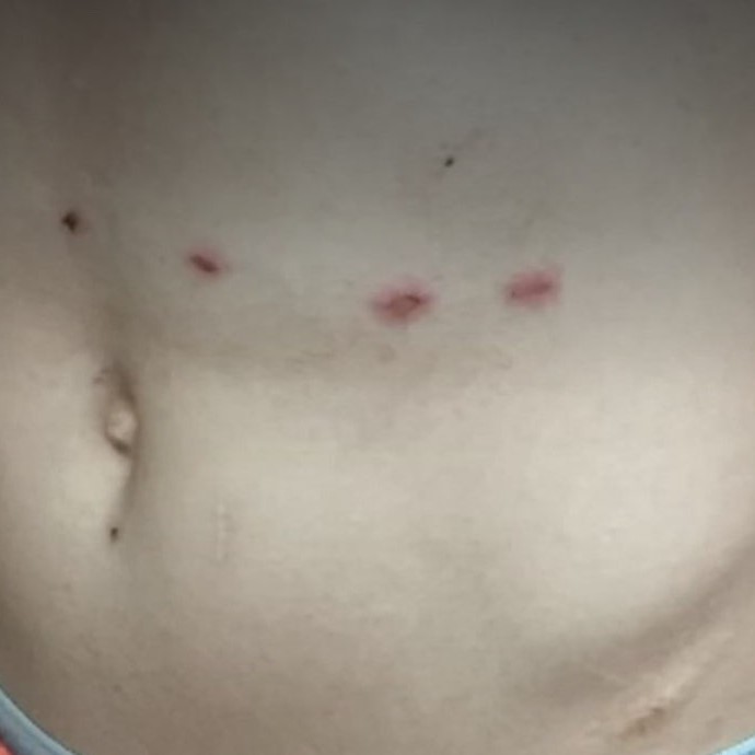 What to Know About Stun Gun Marks: A Guide for Users缩略图 stun gun marks