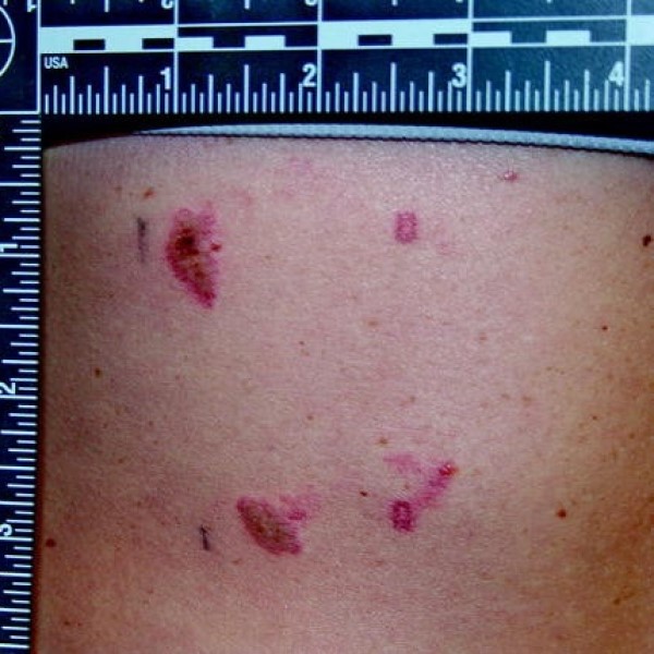What to Know About Stun Gun Marks: A Guide for Users插图2 stun gun marks