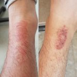 frostbite from ice pack