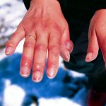 what is the best prevention for frostbite?