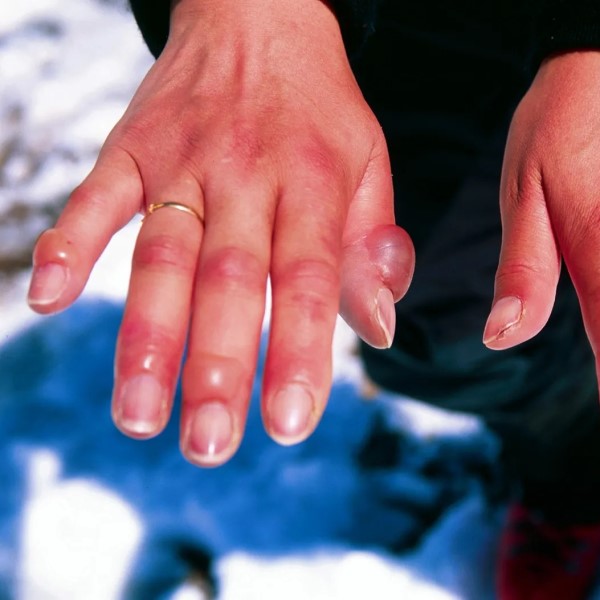Find Out What Is the Best Prevention for Frostbite in Extreme Cold缩略图 what is the best prevention for frostbite?