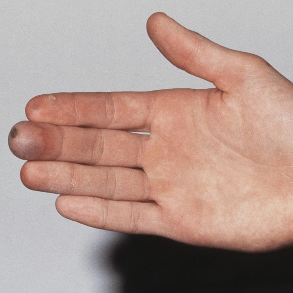 what is the best prevention for frostbite?