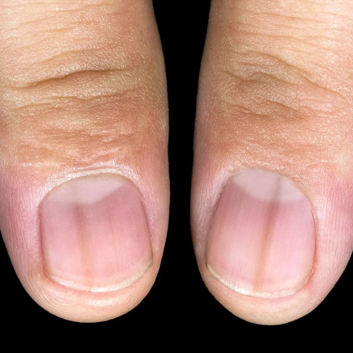 nail turning black without injury