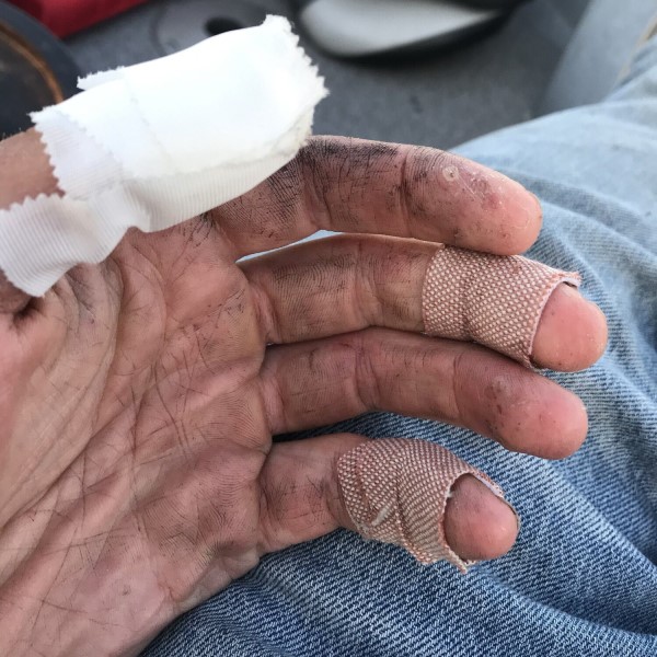 pike bite injury