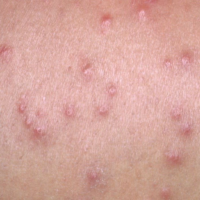 what does a bed bug bite look like