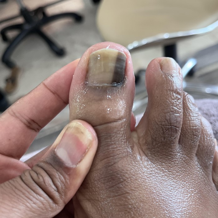 nail turning black without injury