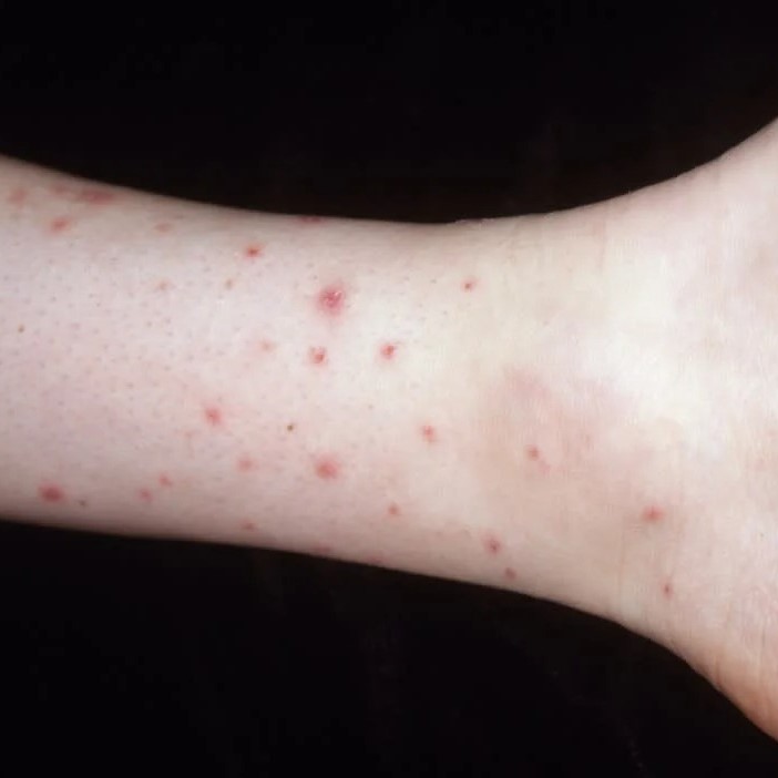 do fleas bite humans