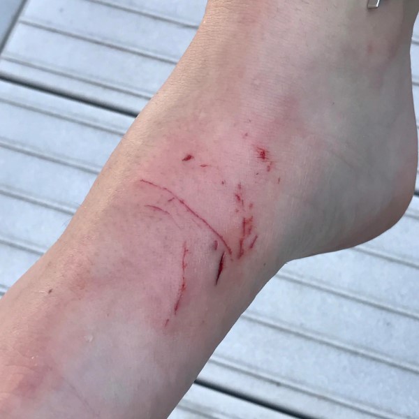pike bite injury