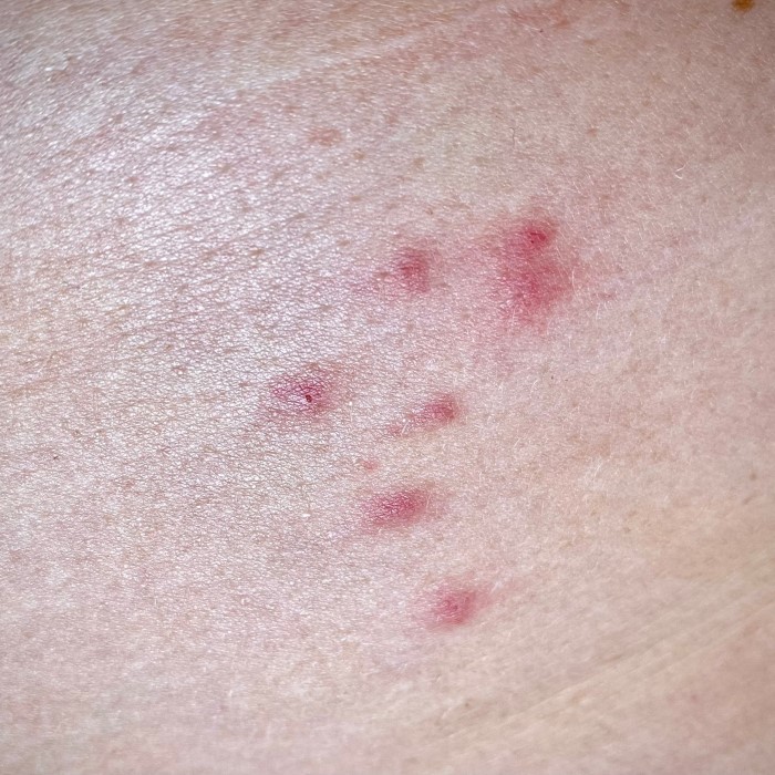 do fleas bite humans