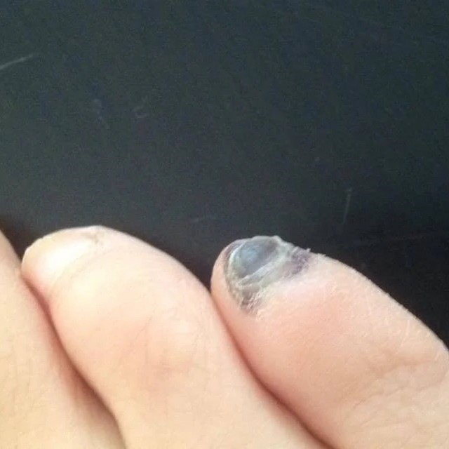 nail turning black without injury