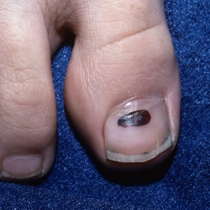 nail turning black without injury