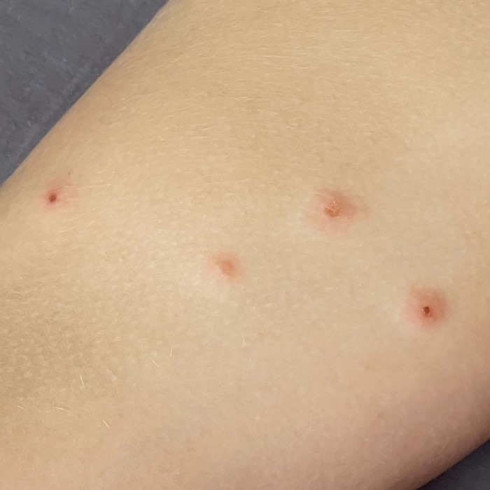 what does a bed bug bite look like