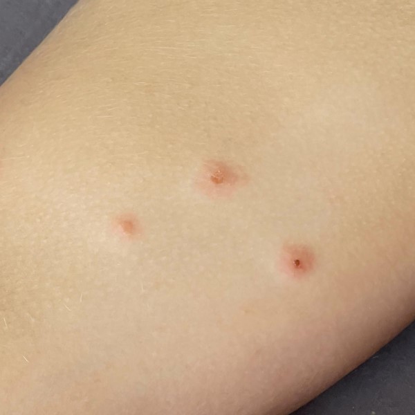 do fleas bite humans