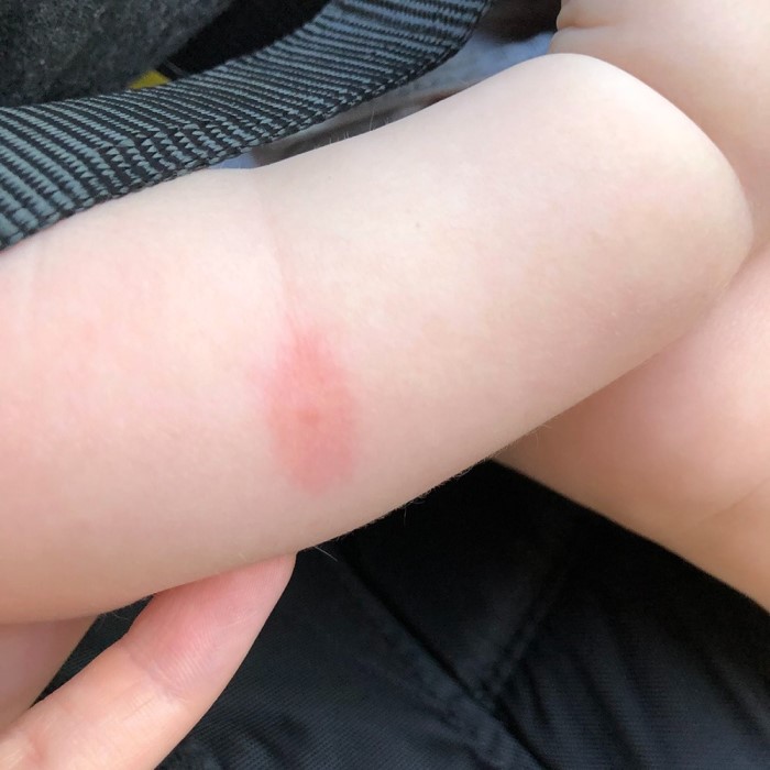 what does a bed bug bite look like