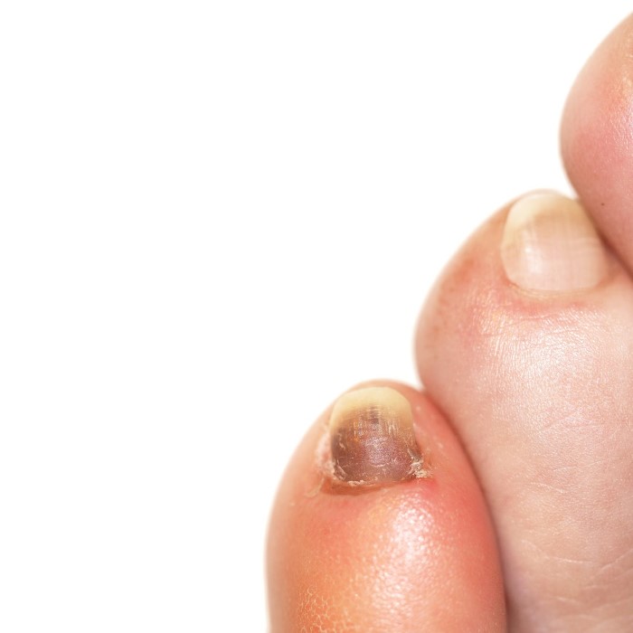 nail turning black without injury