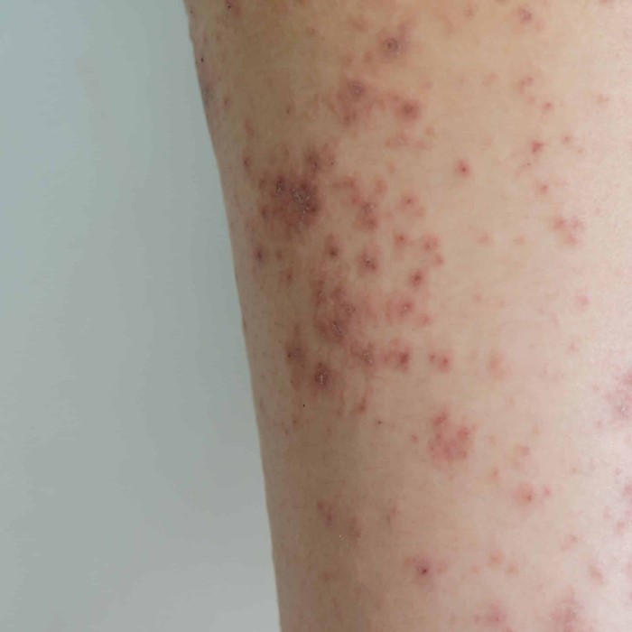 what does a bed bug bite look like