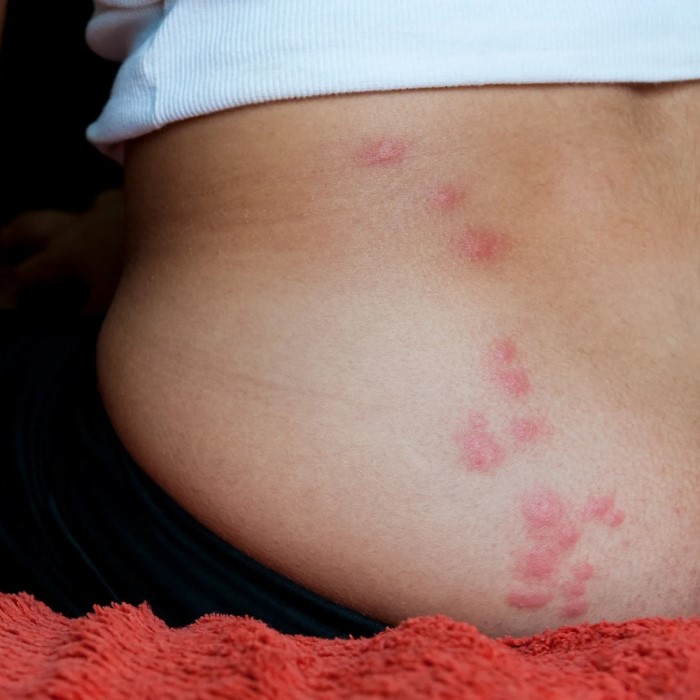 what does a bed bug bite look like